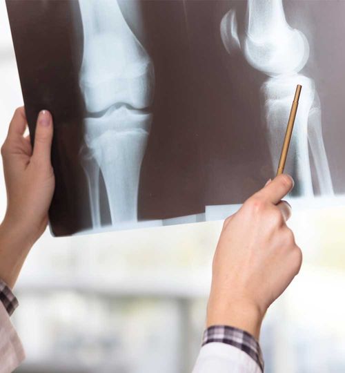 Radiografía de Rodilla Comparativa