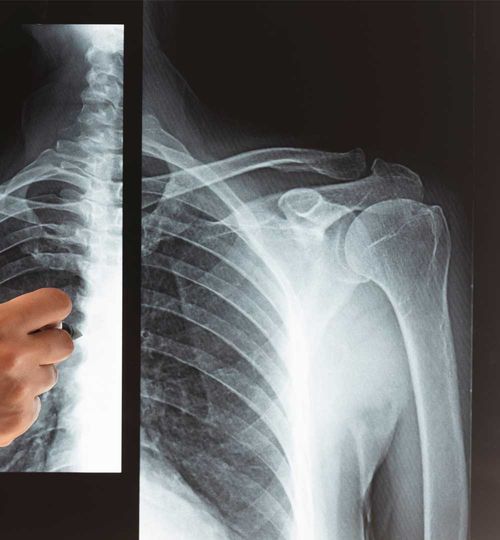 Radiografía de Hombro Izquierdo